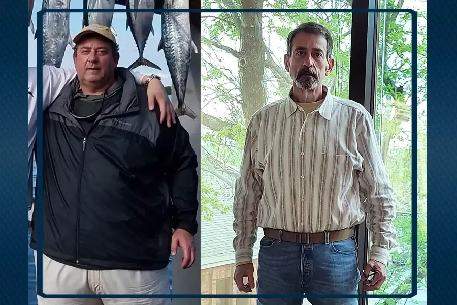 Jeff McKinney's, a patient who underwent bariatric surgery, before and after photos.